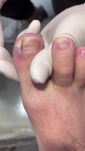 Remove bad nail #fypシ #fyp #unhas #pedicure #ingrowntoenail