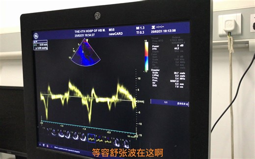 心脏超声入门教程2——心脏超声组织多普勒（TDI）讲解