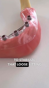 1.5K reactions · 26 shares | Learn the One Piece Dental Implant...