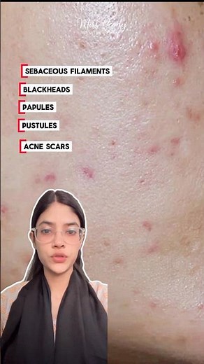 Papules, Pustules & Acne Scars Explained (Must Watch!)