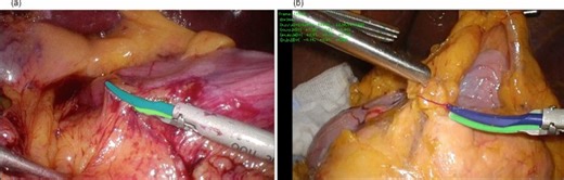 Laparoscopic distal gastrectomy skill evaluation from video: a new artificial intelligence-based instrument identification system - Scientific Reports