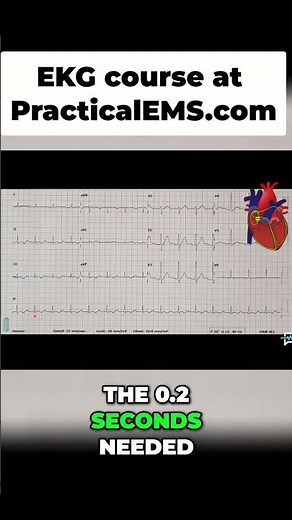 First Degree AV Block: Quick EKG Guide for Beginners! #shorts