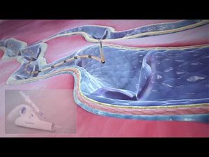Mechano-chemical Ablation (MOCA)