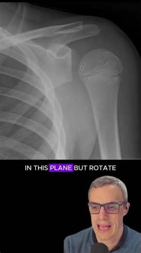 Paediatric posterior shoulder dislocation #radiology #radiographer #pediatrics