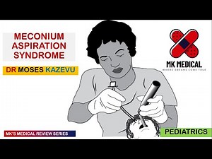 Meconium Aspiration Syndrome || MAS