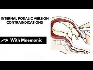 Internal Podalic Version Contraindications With Mnemonic | Obstetrics Mnemonics | Dr Mubashar Ata