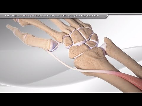 CMC Suspensionplasty With APL Graft and InternalBrace™ Ligament Augmentation
