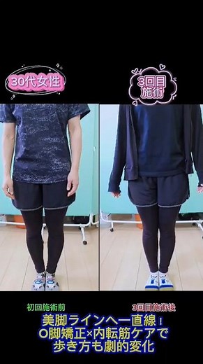 美脚ラインへ一直線！O脚矯正×内転筋ケアで歩き方も劇的変化【30代女性・3回目施術】