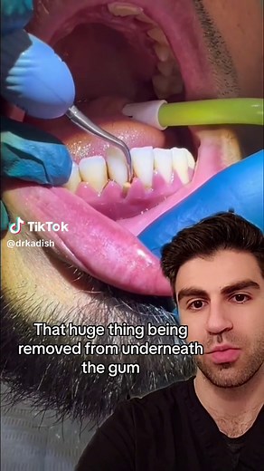 Swollen Gum After Teeth Cleaning: Causes and Remedies