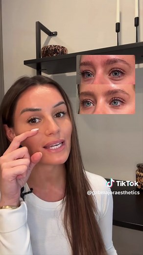 Understanding Jelly Roll Botox: Under Eye Treatment