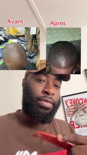Temoignage d’un de mes clients qui avait les contours reculés, après 1 mois d’utilisation du Minoxidil et du derma roller le résultat est juste waoo!!! #creatorsearchinsights #tiktoktogo🇹🇬 #minoxidil #dermaroller