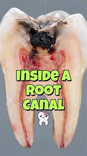 Dentistry blog on Instagram: "Whata great demonstrative video of a root canal treatment By @dr.ammar02 ⁨ ⁨ ⁨ ⁨ ⁨"