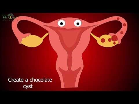 How Chocolate cyst formed? Symptoms of chocolate cyst.