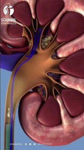Traitement des calculs rénaux : Ce que vous devez savoir sur l'urétéroscopie
