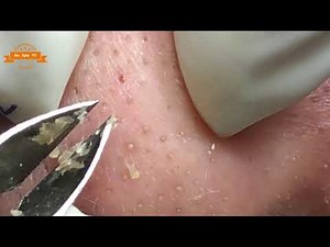 Best Satisfying Nose Plucking Blackheads Whiteheads Removal | Acne Treatment #18