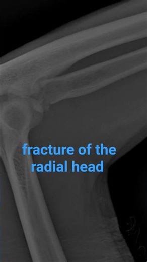 fracture of the radial head