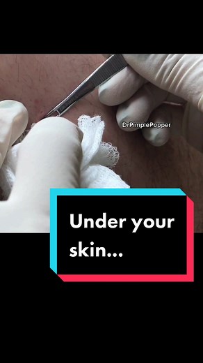 Whatchu got under your skin? #drpimplepopper #SLMDskincare #learnontiktok