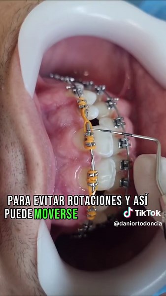 Centrar Conoides: Técnica de Ortodoncia Efectiva