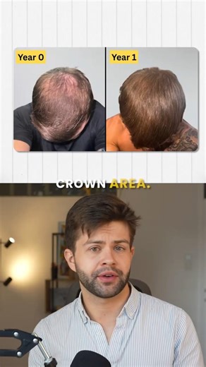 1 Year Finasteride Results #finasteride