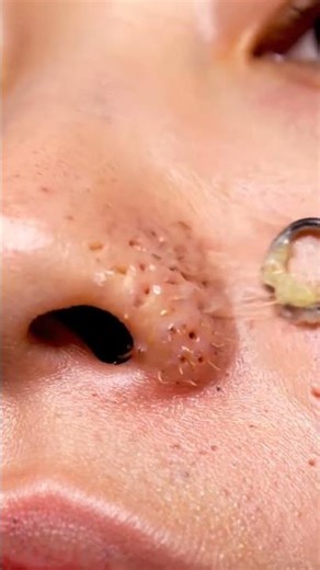 Satisfying Pore Vacuum Cleaning | Blackheads Gone!