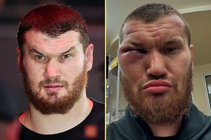 ‘Looks like a water balloon’ – Giant Russian heavyweight shows off gruesome eye injury after knockout defeat