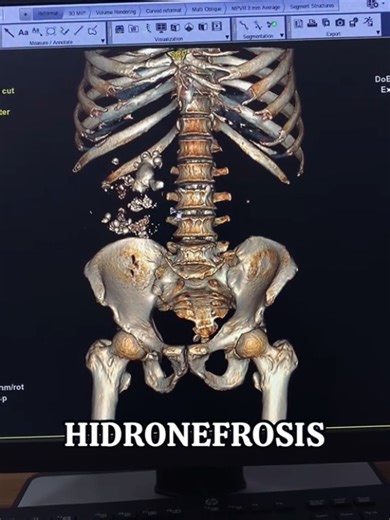 Understanding Hydronephrosis: Causes, Symptoms, and Treatments