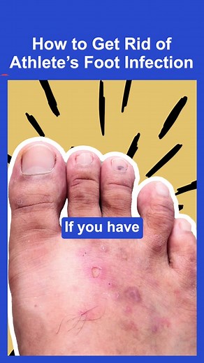 Try this easy athlete's foot hack. Formulated with natural ingredients, EMUAIDMAX® quickly eliminates smelly, dry, and peeling skin caused by athlete's foot fungus. Comes with a 30-day money-back guarantee. #emuaidworks #emuaidmaxathletesfoot #athletefoot #athletesfoot