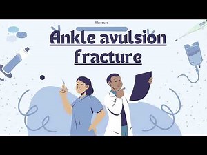 Ankle avulsion fracture, Causes, Signs and Symptoms, Diagnosis and Treatment.