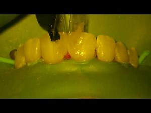 Closing Spaces Between Front Teeth - Bioclear Technique