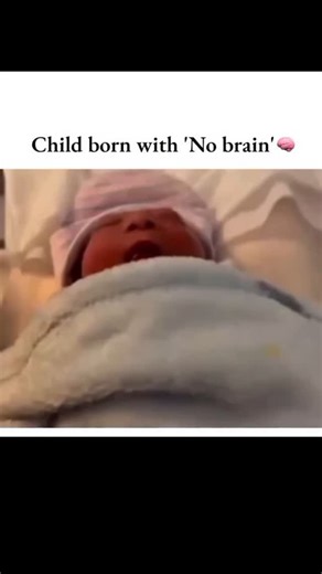 Fact Storrm | 🩺 This condition is called anencephaly, a rare and severe birth defect where a baby is born without major portions of the brain and skull.... | Instagram