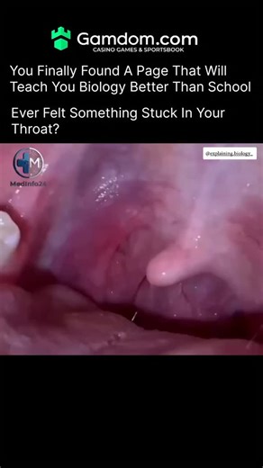 Innovation.09 on Instagram: "Tonsil stones, or tonsilloliths, are small white or yellow clumps that form deep inside the tiny pockets of your tonsils. They happen when food particles, mucus, and dead cells get trapped and bacteria start breaking them down. Over time, this buildup hardens into a stone-like lump. Even though they’re usually harmless, tonsil stones can cause bad breath, a scratchy throat, ear pain, difficulty swallowing, or a weird taste in your mouth. Many people don’t even know t