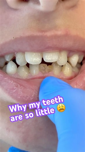 Why my teeth are so little! I don’t like my smile #chatteringteeth #mouths #supersmile