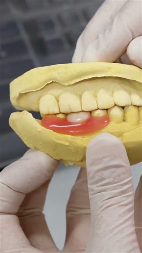 Flipper denture #dentures #flipper #flexible #3dprinting #dentallab