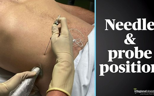 Ultrasound Guided Transversus Abdominis Plane (TAP) Block