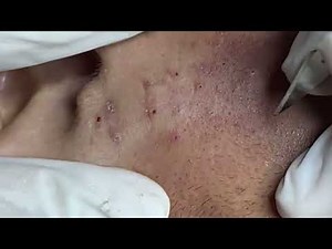 Experts remove blackheads in the ear canal