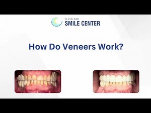 How do Porcelain Veneers Work | Cleveland Smile Center Explains