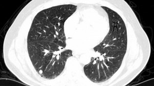 Can You See The Dancing Gorilla In This CT Scan? 83% Of Radiologists Couldn’t