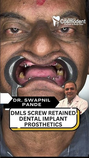 From Toothless to Fixed Teeth in 72 Hours! 😲 Amazing Full Mouth Transformation