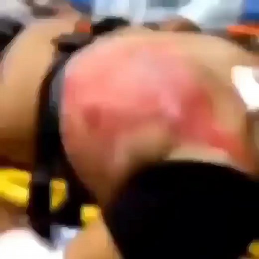 Learn Doctor™ | ⚠️ The video shows a patient with a condition known as flail chest! Flail chest refers to a type of injury that follows a blunt trauma to... | Instagram