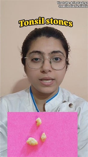 Day-161 Yeh Galti = Infection 😬 Tonsil Stones Warning! Biggest Mistake ‪@Smilediariesindia‬