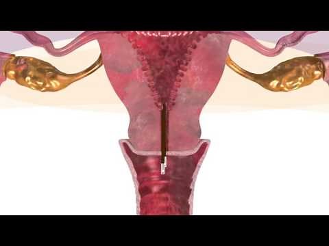 How Dilapan-S Cervical Dilator Work