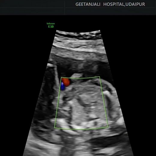 Hypoplastic left heart syndrome (HLHS).