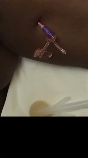 patient - powerglide blood return.mp4