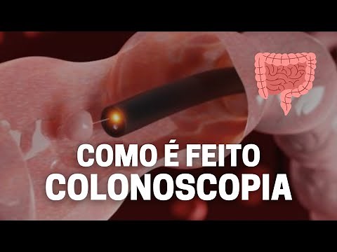 Como é o exame de colonoscopia? [MOSTRANDO TUDO]