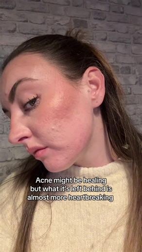 Pitted scars were not something I ever considered il be honest. In the pits of acne your only thinking about how you can heal it but no one talks about once it’s healed and the damage it’s done to your skin. Sending love to you all ❤️ #acne #acnepositivity #acneproneskin #acnecheck #fyp