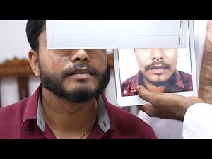 Beard Transplant Surgery Before and After - Beard Transplant 5 Month Amazing Result