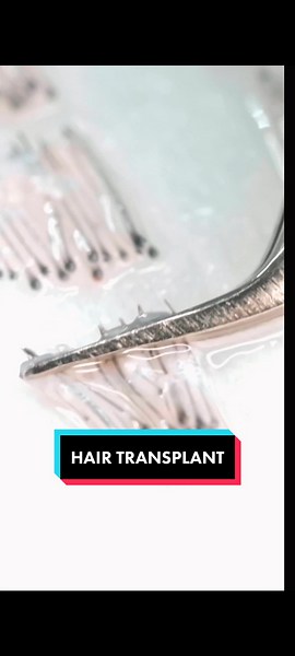 . HAIR DOCTORS’ MICRO FUE AND DHI IMPLANTATION SIGNATURE METHOD - GIVES YOU NATURAL RESULTS AND HIGHEST HAIR GRAFT SURVIVAL RATES!😷💉 . For more information visit our website www.hairdoctors.com.au, call us on (02) 7252 3351 or leave us an email info@hairdoctors.com.au . . . . #hairtransplant #sydney #sydneyaustralia #australia #fue #hairrestoration #newsouthwales
