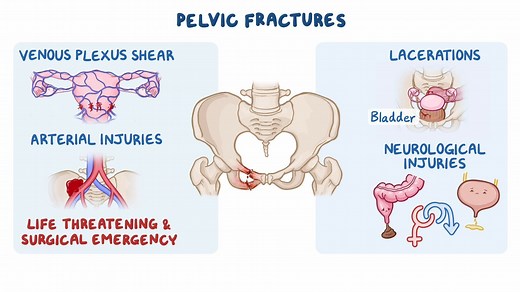 Video: Pelvic fractures: Clinical sciences - Video Explanation! | Osmosis | Osmosis