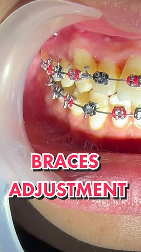Black & Red Braces Adjustment Tutorial
