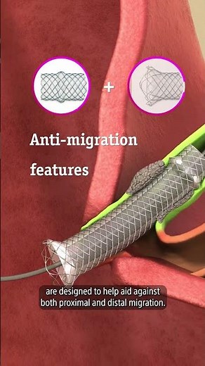 WallFlex™ Biliary Plus RX | Design & Deployment Overview | Boston Scientific